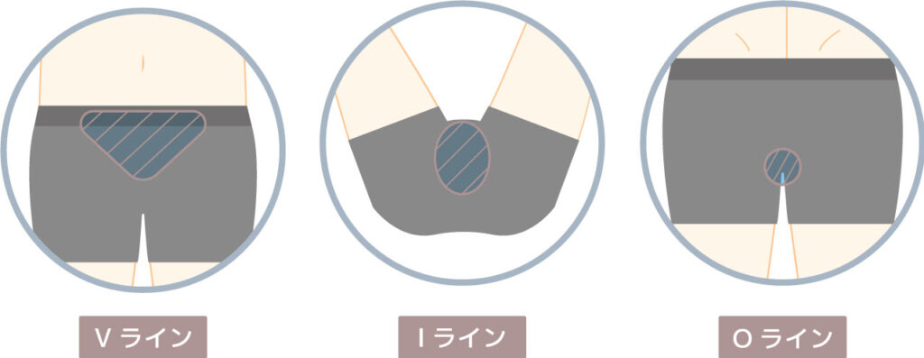 Vライン（陰毛）、Iライン（肛門）、Oライン（陰部）の場所図